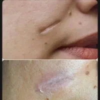 لیزر موفیشال لاغری پوست فیلر بوتاکس ویژه بانوان|خدمات آرایشگری و زیبایی|خمینی‌شهر, |دیوار