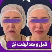 لیفت جراحی بینی بلفارو ژل لب بوتاکس مزو فشیال|خدمات آرایشگری و زیبایی|شاهین‌شهر, طالقانی|دیوار