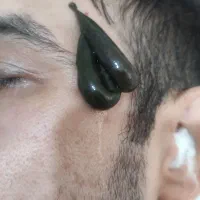 خدمات حجامت زالو درمانی فصد خون تزریقات|خدمات زیبایی و سلامت|تهران, بریانک|دیوار
