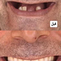 دندان مصنوعی بدون سقف *فلکسیبل*جایگزین ایمپلنت|خدمات زیبایی و سلامت|تهران, دولت‌آباد|دیوار