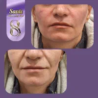 بوتاکس رایگان|خدمات آرایشگری و زیبایی|همدان, |دیوار