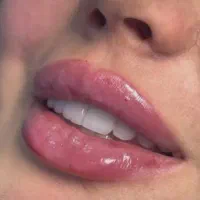 ژل بوتاکس