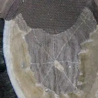 ترمیم انواع پروتز موی مردانه و زنانه