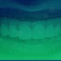 دندانپزشکی، بلیچینگ رایگان