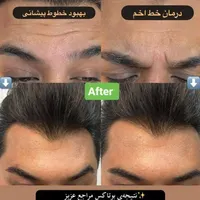 بوتاکس ژل آنزیم نخ لاغری بوتاکس 500وژل اودری350|خدمات آرایشگری و زیبایی|قم, هفت تیر|دیوار
