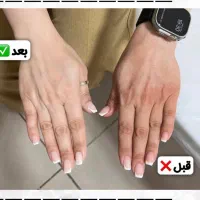 تخفیف لیزر اشنایدرپلاس و روشن سازی نواحی تیره|خدمات آرایشگری و زیبایی|بندرعباس, |دیوار