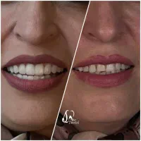 ایمپلنت و زیبایی دندان اقساط ۱۲ ماهه اکو دنتال|خدمات آرایشگری و زیبایی|تهران, خانی آباد نو شمالی|دیوار