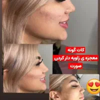 تزریق ژل و بوتاکس و مزو ژل