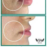 درمان حرفهای لک و ککومک و مزو تراپی|خدمات آرایشگری و زیبایی|برازجان, |دیوار