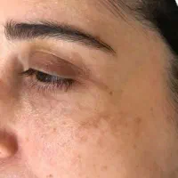 برداشتن لک و کک و مک|خدمات آرایشگری و زیبایی|نورآباد, |دیوار