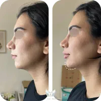 تخفیفات ویژه بوتاکس، فیلر، ژل لب، prp توسط پزشک|خدمات زیبایی و سلامت|مشهد, احمدآباد|دیوار