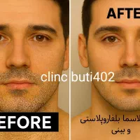 لیزرمیکرو پلاسمالیفت زیبایی/ بینی شیک/بلفاروپلاستی