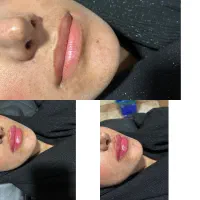 ژل بوتاکس|خدمات آرایشگری و زیبایی|دورود, |دیوار