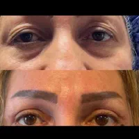 لیپوساکشن شکم و پهلو،ترنسفر به باسن،هایفودابلوگولد|خدمات آرایشگری و زیبایی|اصفهان, دشتستان|دیوار