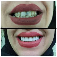 ساخت دندان مصنوعی باکیفیت وضمانت|خدمات آرایشگری و زیبایی|نهاوند, |دیوار