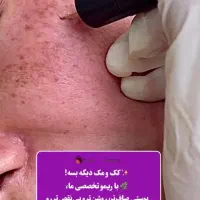 فروش دستگاه نانو الکترولیز برداشتن کک و مک|آرایشگاه و سالن‌های زیبایی|مشهد, نیروی هوایی|دیوار