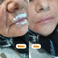 بوتاکس/فیلر/مزوتراپی/پی آر پی/فیلر بادی توسط پزشک