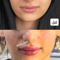 تخفیفات استثنایی ژل و بوتاکس در مطب زیبایی|خدمات آرایشگری و زیبایی|قم, زنبیل آباد|دیوار