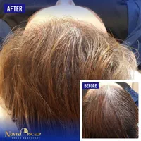 میکرواسکالپ / اسکالپ تخصصی سر/ جایگزین کاشت مو|خدمات آرایشگری و زیبایی|مشهد, وکیل‌آباد|دیوار