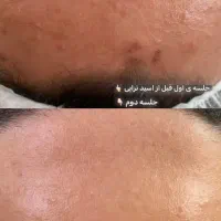 پاکسازی،فیشال درمان مشکلات پوستی|خدمات آرایشگری و زیبایی|زابل, |دیوار