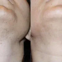 لیزر،بوتاکس، مزوتراپی، فیلر،وایتینگ|خدمات آرایشگری و زیبایی|هشترود, |دیوار