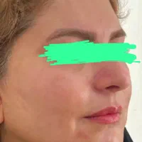 کرم ضد لک تخصصی|آرایشی، بهداشتی، درمانی|ایرانشهر, |دیوار