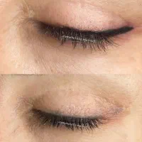 ریموو تتو صورت(پاک کردن تتو)، بنمژه،شیدلب