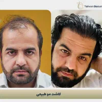 کلینیک زیبایی / کاشت مو ابرو / زاویه فک بینی / پلک