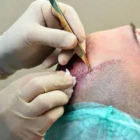 آموزش تخصصی کاشت مو