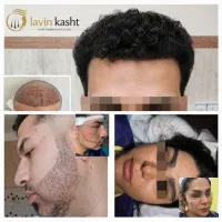 کاشت مو ابرو و ریش بدون جراحی با تکنسین شیرازی