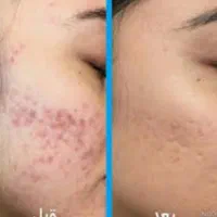 پاکسازی پوست