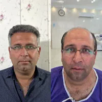 جشنواره کاشت مو بهاره