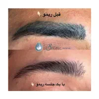 اولین مرکز ریموو با برند انحصاری و تضمینی