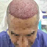 جشنواره کاشت مو|خدمات آرایشگری و زیبایی|شیراز, قصرالدشت|دیوار