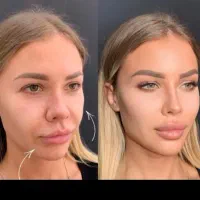 بوتاکس مصپورت تخفیف ویژه عیدانه