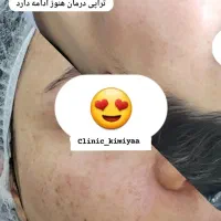 ریموو تتو صورت وبدن +کربن ولک تراپی