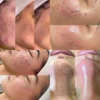 جشنواره آموش لیفت مژه و ابرو و فیشیال