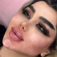 تزریق تخصصی ژل کانتورینگ صورت وزاویه فک وفیشیال|خدمات آرایشگری و زیبایی|کرج, گلشهر|دیوار