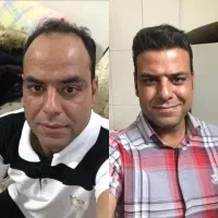 کاشت مو پرتراکم باکیفیت عالی و دائمی|خدمات آرایشگری و زیبایی|رشت, پارک شهر|دیوار