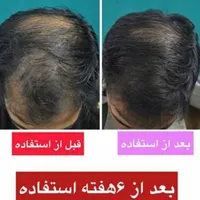 درمان قطعی ریزش مو|آرایشی، بهداشتی، درمانی|رشت, کوی جام جم|دیوار