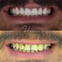 ایمپلنت و لمینیت اقساطی ( فولادشهر )|خدمات آرایشگری و زیبایی|فولادشهر, B2|دیوار