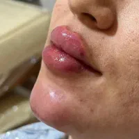 فیلر و بوتاکس پرسینگ چال لپ...|خدمات آرایشگری و زیبایی|قرچک, شهرک گلها|دیوار