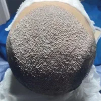 جشنواره عیدانه کاشت مو،ریش،ابرو،بلفاروپلاستی