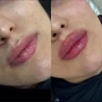 جشنواره یلدایی بوتاکس و فیلر لب