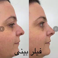 تزریق ژل لب بوتاکس زاویه سازی گونه فول فیس هایفو۲۴|خدمات آرایشگری و زیبایی|مشهد, احمدآباد|دیوار