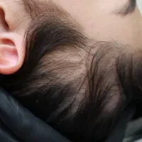 رفع کم پشتی مو با میکرو اسکالپ سر