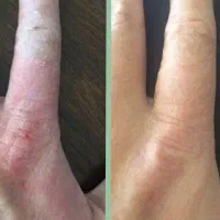 لک های پوستی،راهکار نوین مراقبت پوست مبتلا به پیسی|آرایشی، بهداشتی، درمانی|شیراز, شاهچراغ|دیوار