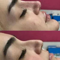 تزریق ژل و بوتاکس فقط ۵۰۰هزارتومان|خدمات آرایشگری و زیبایی|فولادشهر, B2|دیوار