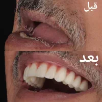 ایمپلنت دندان کاشت و روکش فوری اوردنچر از دم اقساط|خدمات آرایشگری و زیبایی|تهران, قیطریه|دیوار