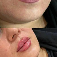 تخفیفات 50% ژل و بوتاکس شروع قیمت از ۳۰۰ت|خدمات آرایشگری و زیبایی|قم, سالاریه|دیوار